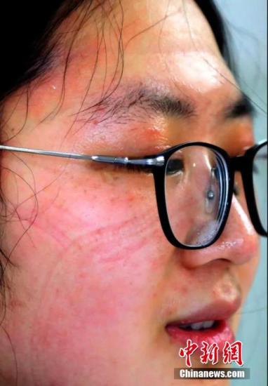 一名医护人员素颜的脸上勒痕久难褪去。供图